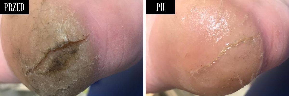 Zespół pękających pięt