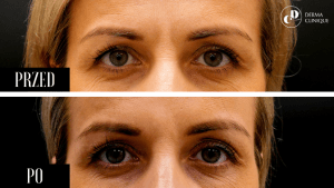 Botox działanie w spoczynku