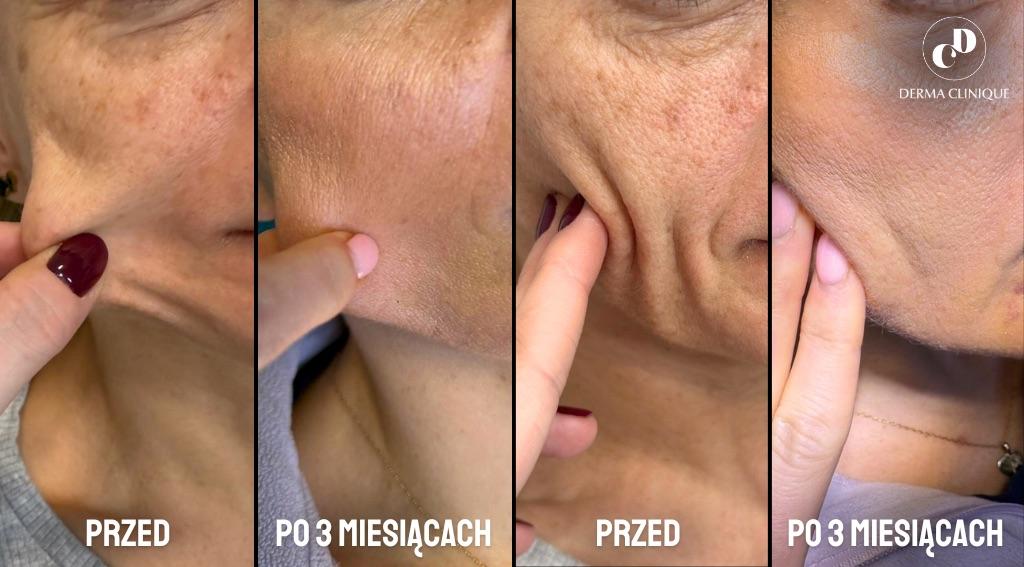 Kwas polimlekowy – najmocniejszy stymulator tkankowy