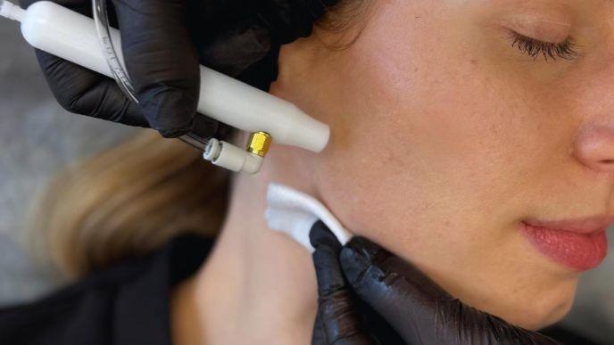 Oxybrazja – peeling tlenowo-wodny dla skóry wrażliwej i naczyniowej